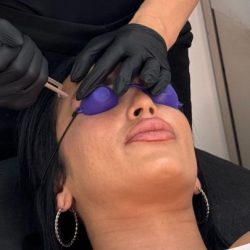 Eliminacion de micropigmentacion con láser Q-SWITCHED ND YAG fotoacustico ss 2